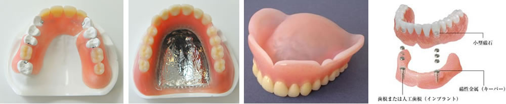特徴の違う入れ歯