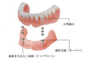 磁石アタッチメントデンチャー