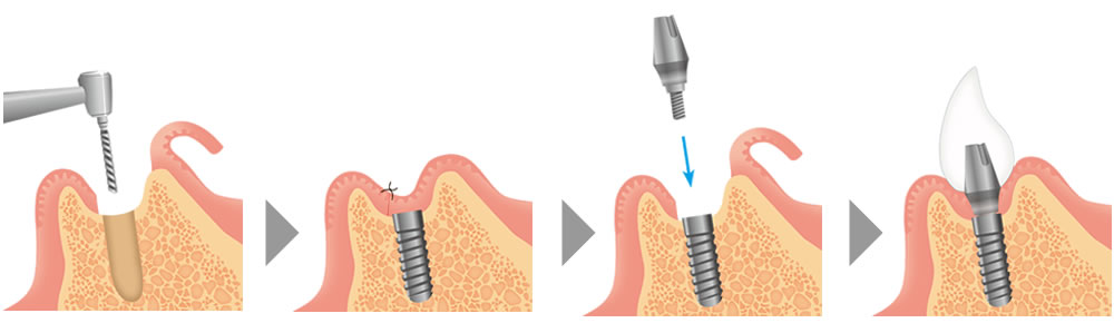 インプラント治療の流れ