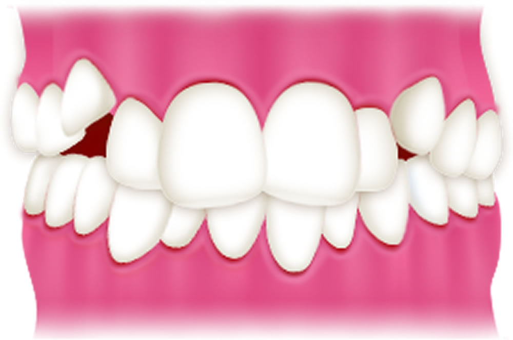 叢生（でこぼこの歯列）