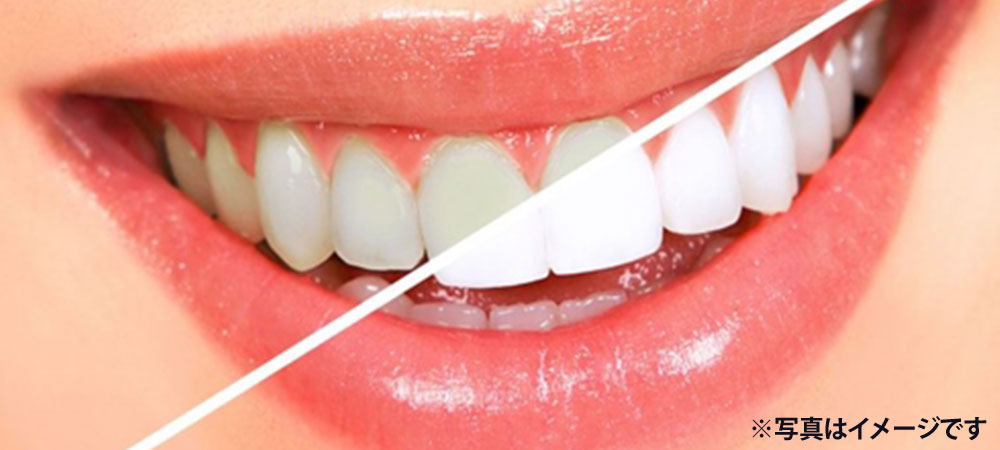 ホワイトニング治療